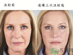 3D液態(tài)拉皮多少錢？3D液態(tài)拉皮后多久見(jiàn)效？