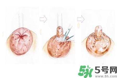 乳頭內(nèi)陷怎么矯正？乳頭內(nèi)陷矯正方法是什么？