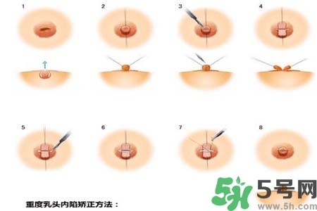 乳頭內(nèi)陷怎么矯正？乳頭內(nèi)陷矯正方法是什么？