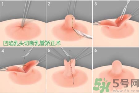 乳頭內(nèi)陷怎么矯正？乳頭內(nèi)陷矯正方法是什么？