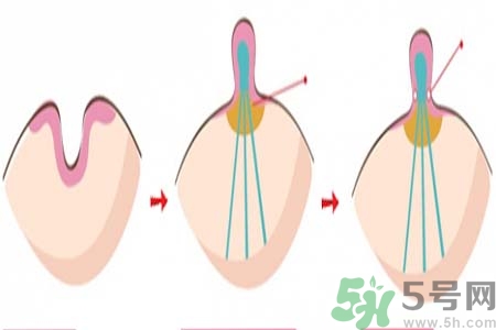 乳頭內(nèi)陷矯正需注意什么？乳頭內(nèi)陷如何預(yù)防？