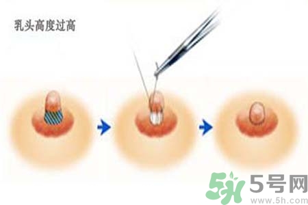 乳頭內(nèi)陷能不能喂奶？乳頭凹陷怎樣哺乳？