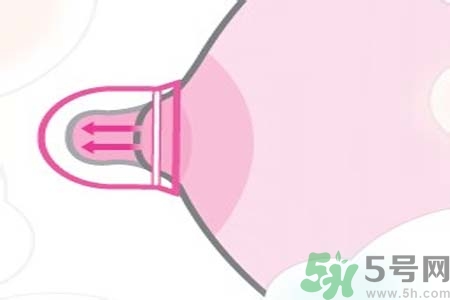 乳頭內(nèi)陷可以拔罐嗎？乳頭內(nèi)陷需要手術(shù)治療嗎？