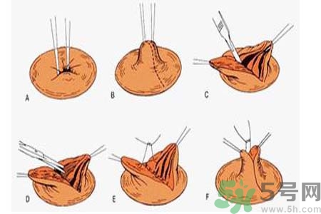 乳頭內(nèi)陷可以拔罐嗎？乳頭內(nèi)陷需要手術(shù)治療嗎？