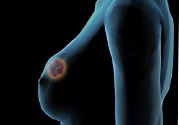 哺乳期乳房有硬塊疼痛怎么辦？如何預防哺乳期乳房有硬塊？