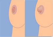 乳頭內(nèi)陷可以用吸奶器嗎？乳頭內(nèi)陷能不能用吸奶器？