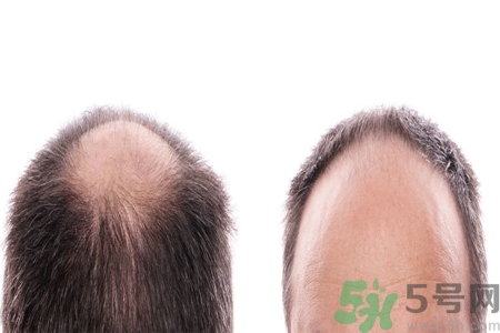 頭發(fā)稀少的原因是什么？如何預(yù)防禿頂?shù)陌l(fā)生？