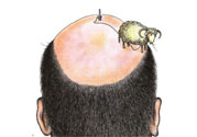 禿頂會遺傳嗎？治療禿頂?shù)姆椒ㄊ鞘裁矗?><p><strong>禿頂會遺傳嗎？治療禿頂?shù)姆椒ㄊ鞘裁矗?/strong></p></a></li> </ul>
</div>
<div   id=