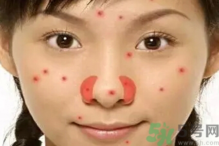 鼻翼長(zhǎng)痘痘怎么回事？鼻翼長(zhǎng)痘痘的原因是什么？