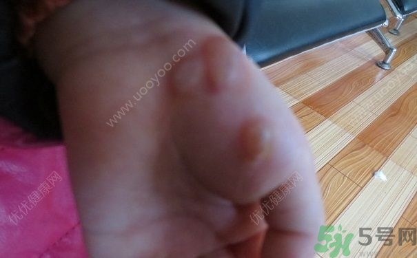 15歲還會(huì)得手足口病嗎？手足口病的癥狀有哪些？