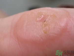手上長(zhǎng)水泡是什么原因?手上長(zhǎng)水泡很癢怎么辦?