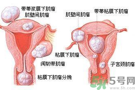 ?子宮移位怎么治療？子宮移位能懷孕嗎？
