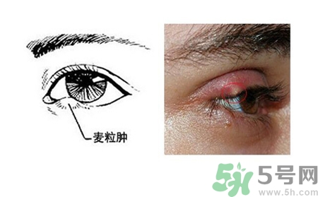 眼皮里長了個疙瘩是怎么回事?眼睛里長了個小白點(diǎn)怎么辦?