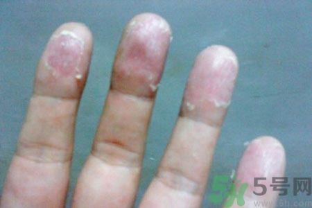 ?手掌脫皮的危害有哪些？如何預(yù)防手掌脫皮？