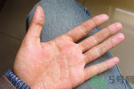 ?手掌脫皮的危害有哪些？如何預(yù)防手掌脫皮？