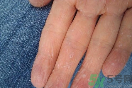 ?手掌脫皮的危害有哪些？如何預(yù)防手掌脫皮？