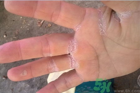 手脫皮是什么原因？手脫皮的治療方法是什么？