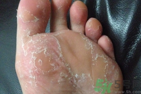 腳脫皮是怎么回事？腳脫皮怎么辦？