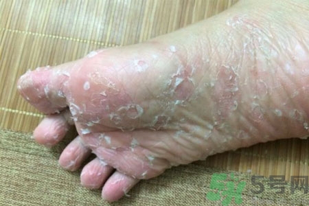 腳脫皮的治療方法有哪些？如何預(yù)防腳脫皮？