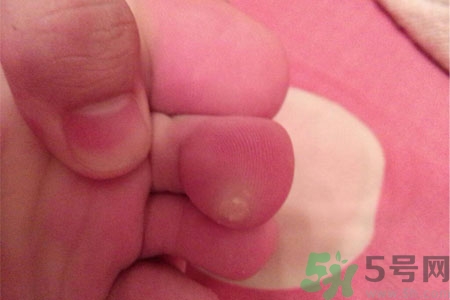 雞眼如何去除？腳上長了雞眼怎么治療？