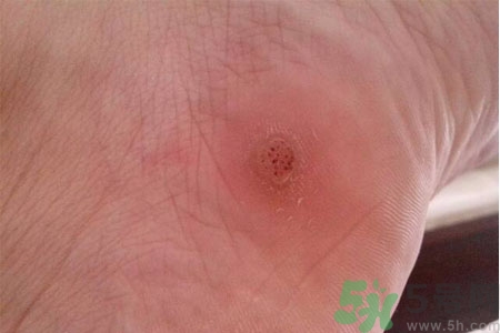 腳上長雞眼是怎么回事？腳上長雞眼是怎么辦？