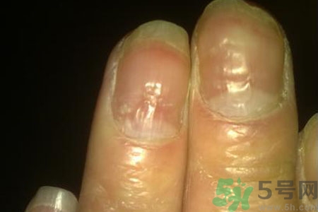 孩子手指甲凹凸不平是什么原因？手指甲凹凸不平的原因是什么？