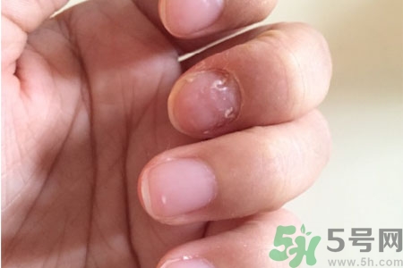孩子手指甲凹凸不平是什么原因？手指甲凹凸不平的原因是什么？