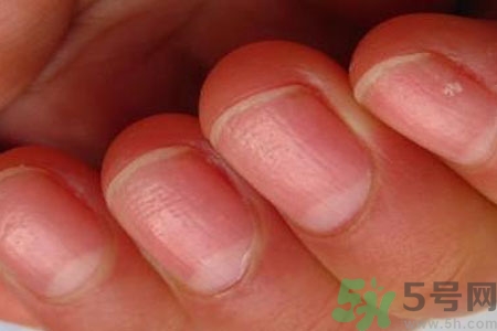 手指甲凹凸不平是怎么回事？如何預(yù)防手指甲凹凸不平？