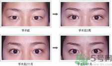 提眉術(shù)后多久可以恢復(fù)？提眉術(shù)后全過程照片