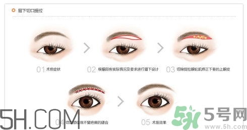 切眉手術(shù)后老得快嗎？切眉能保持多久？