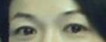 提眉術(shù)后多久可以恢復(fù)？提眉術(shù)后全過程照片