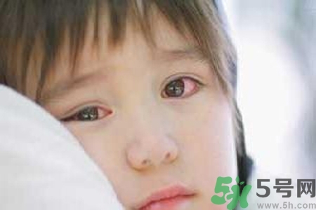 流行性腮腺炎的表現(xiàn)有哪些？?流行性腮腺炎飲食怎么調(diào)理？