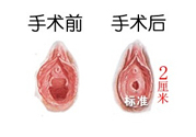 處女膜修補(bǔ)術(shù)效果怎么樣？處女膜修復(fù)手術(shù)有風(fēng)險(xiǎn)嗎？