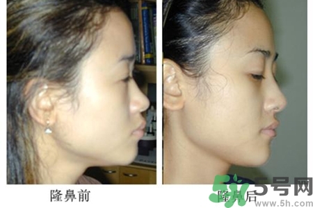 玻尿酸隆鼻的危害有哪些？玻尿酸隆鼻的副作用是什么？