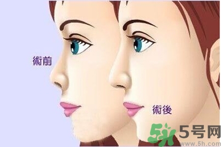 玻尿酸隆鼻的缺點是什么？玻尿酸隆鼻的優(yōu)點有哪些？