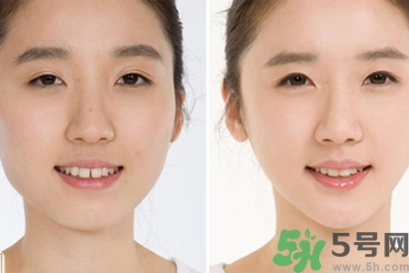 玻尿酸隆鼻的缺點是什么？玻尿酸隆鼻的優(yōu)點有哪些？