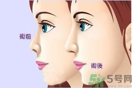 玻尿酸隆鼻和手術(shù)隆鼻的區(qū)別是什么？