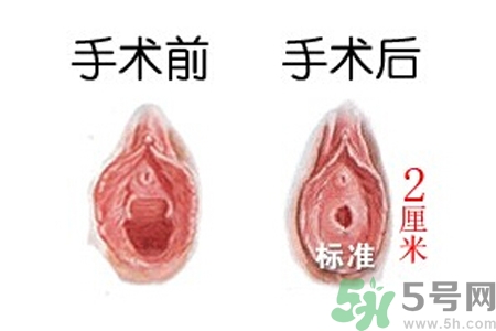 處女膜修補(bǔ)術(shù)效果怎么樣？處女膜修復(fù)手術(shù)有風(fēng)險(xiǎn)嗎？