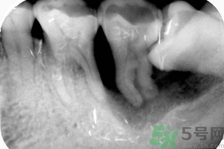 拔智齒一顆多少錢？拔除智齒收費(fèi)多少？