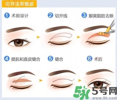 雙眼皮手術(shù)哪種最好？割雙眼皮后注意些什么？