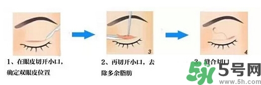 雙眼皮手術(shù)哪種最好？割雙眼皮后注意些什么？