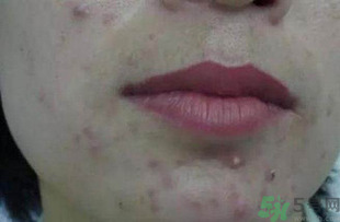 什么樣的痘痘能擠？哪些痘痘不能擠？