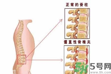 僵直性脊椎炎的癥狀有哪些？怎樣預(yù)防僵直性脊椎炎？