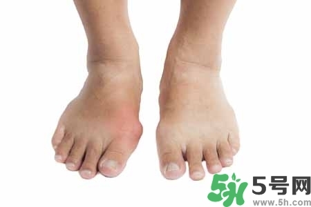 引發(fā)痛風(fēng)的原因是什么？痛風(fēng)病人飲食需注意什么好？