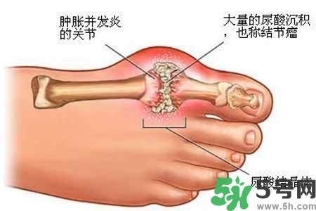 引發(fā)痛風(fēng)的原因是什么？痛風(fēng)病人飲食需注意什么好？