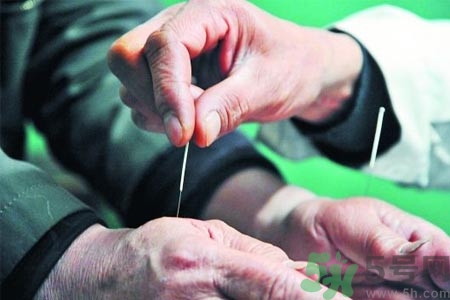針灸一次要扎多長時(shí)間？針灸可以幾天做一次？