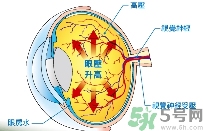 青光眼可以治愈嗎？青光眼怎樣治療？