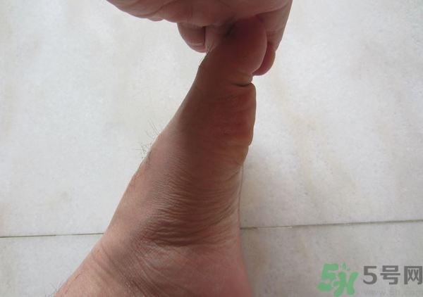 腳拇指外翻遺傳嗎？腳拇指外翻怎么矯正？
