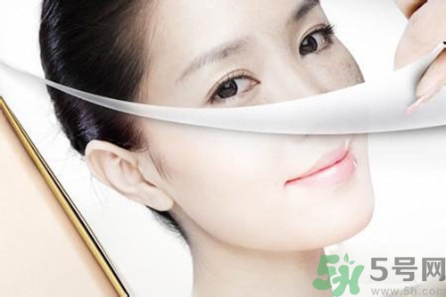 曬斑可以自己消退嗎？曬斑可以用激光去除嗎？