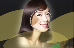 曬斑可以自己消退嗎？曬斑可以用激光去除嗎？
